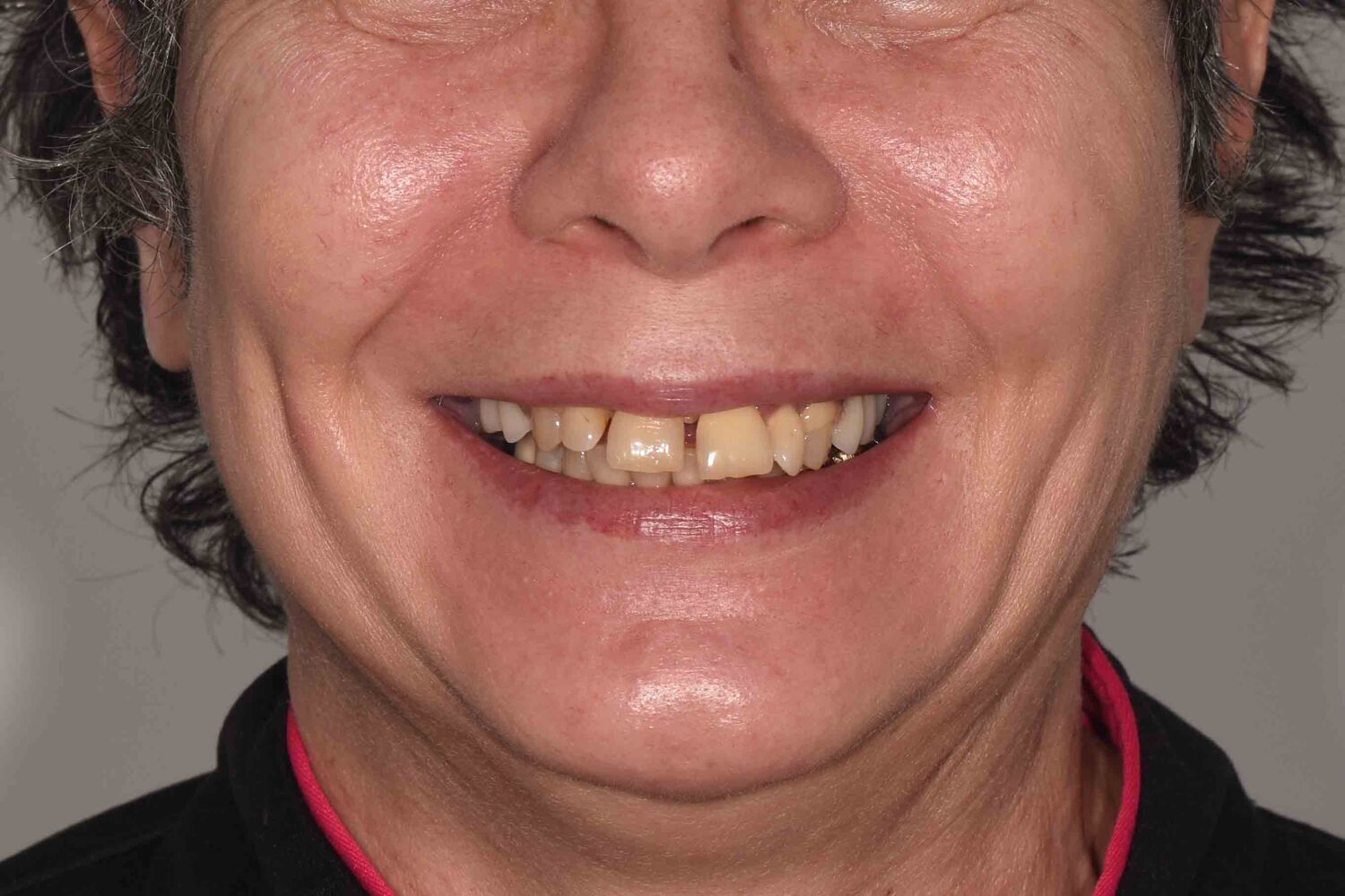 Pacient Clinica Dr. Alin Odor - Rezultat Implantologie
